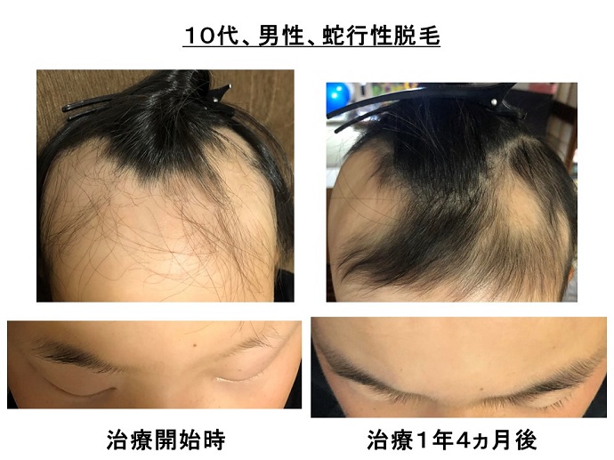 円形脱毛症　病院